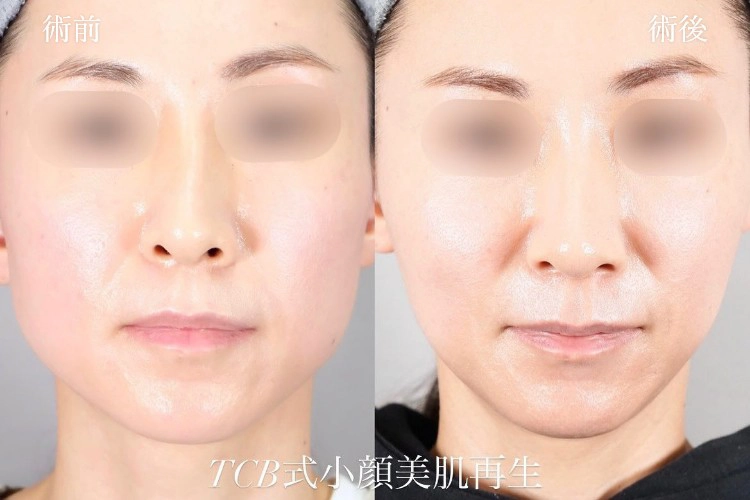 糸フェイスリフトの症例写真