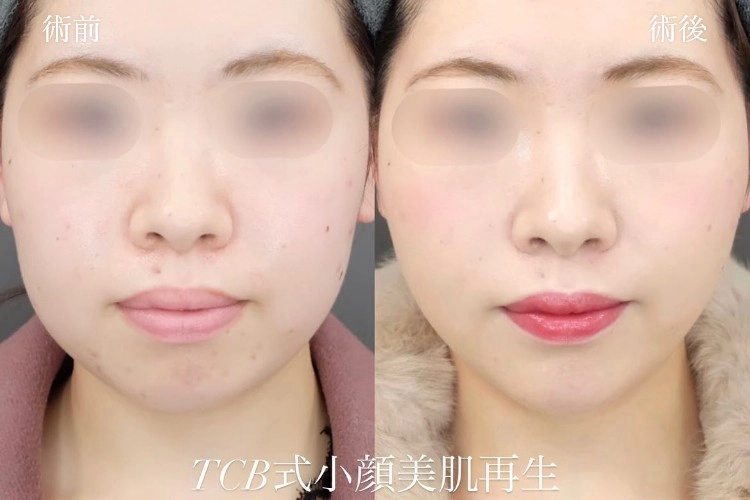 糸フェイスリフトの症例写真