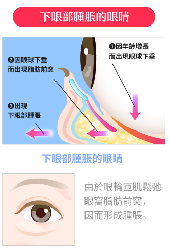 下眼部腫脹的眼睛：①因年齡增長而出現眼球下垂 ②因眼球下垂而出現脂肪前突 ③出現下眼部腫脹