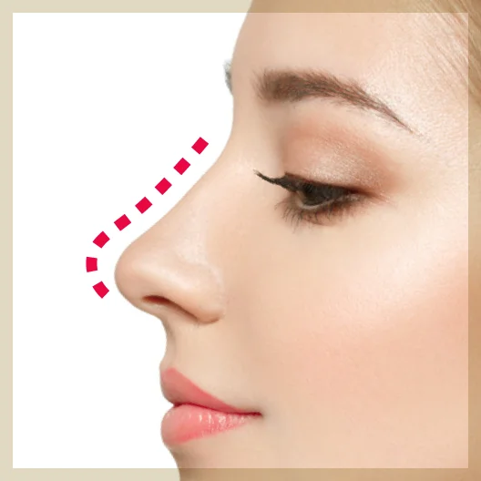 鼻整形施術イメージ画像
