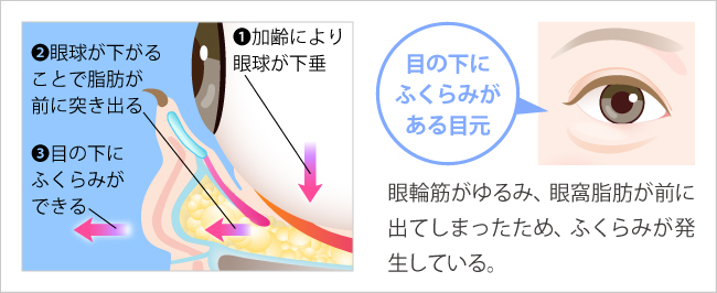 目の下のふくらみが発生する仕組みのイラスト