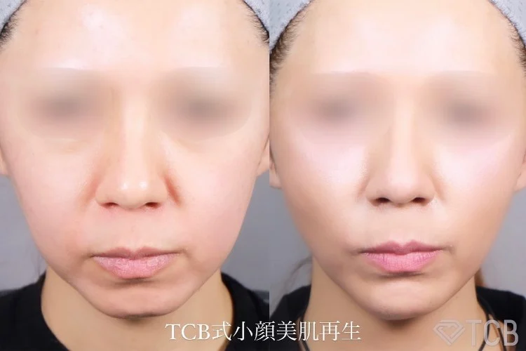 小顔美肌再生の症例写真